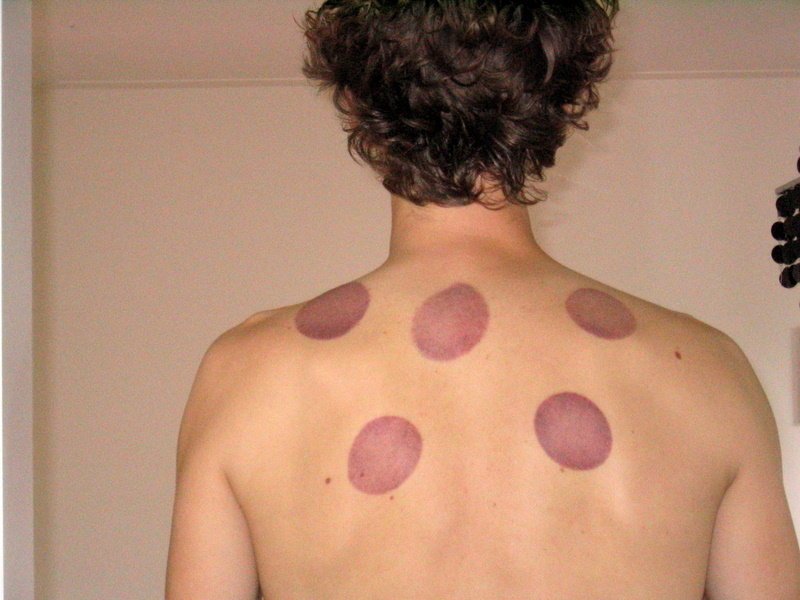 cupping color meaning