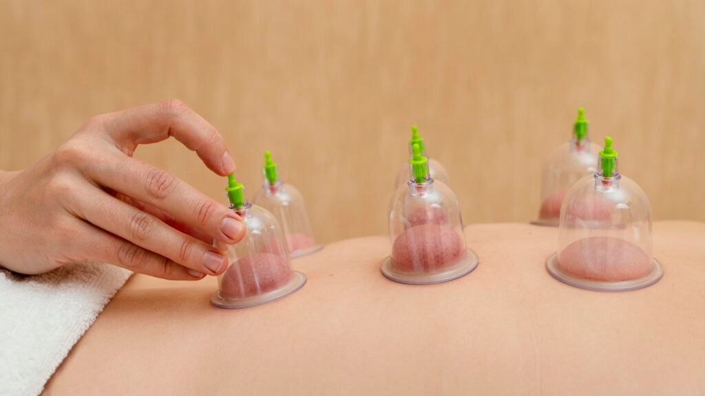 Hijama Therapy